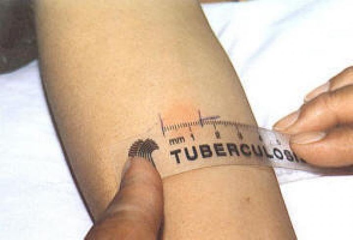 Ukvi Approved Tb Test Centres